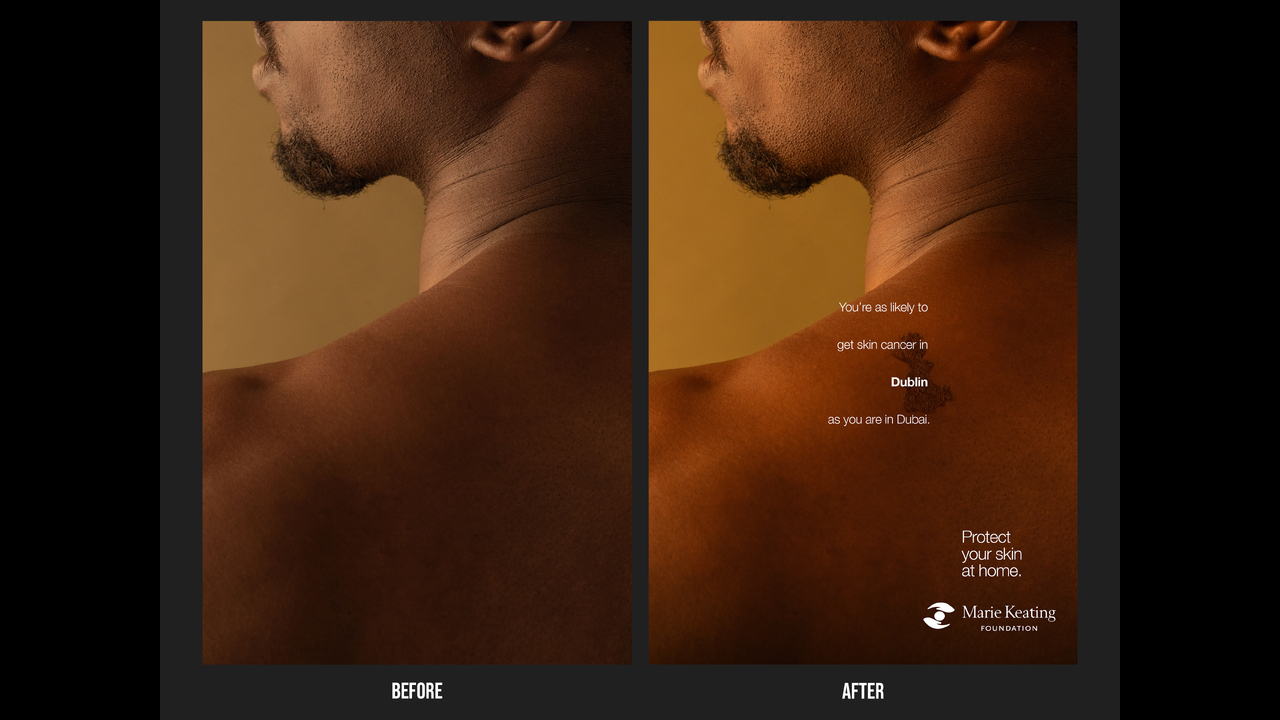 Mole Maps - Skin Cancer - The Marie Keating Foundation