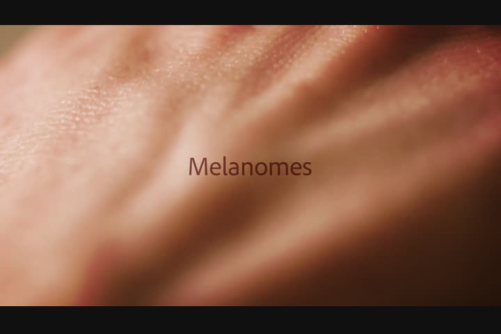 Dotted i's - Public awareness melanomes - Melanoompunt