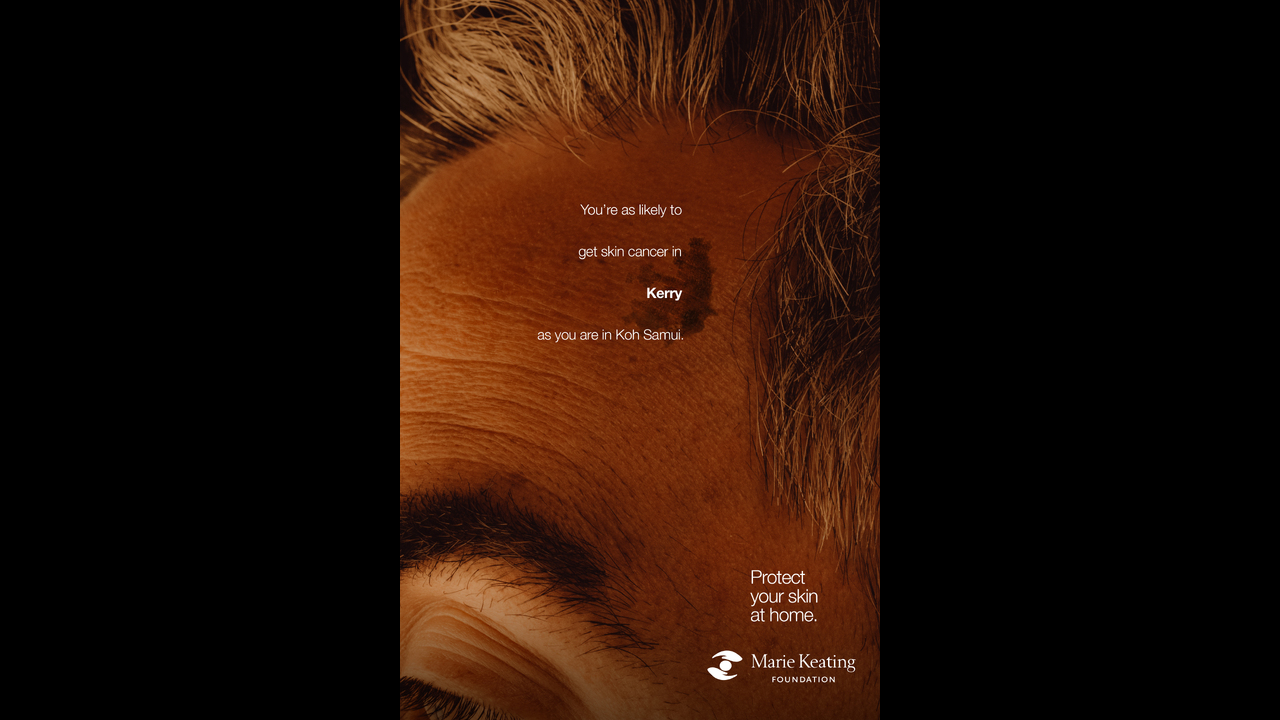 Mole Maps - Skin Cancer - The Marie Keating Foundation