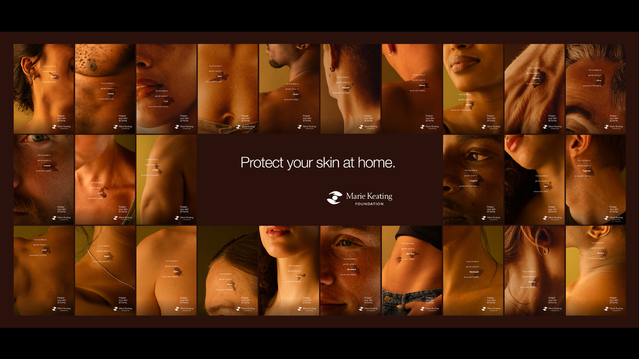 Mole Maps - The Marie Keating Foundation - Skin Cancer