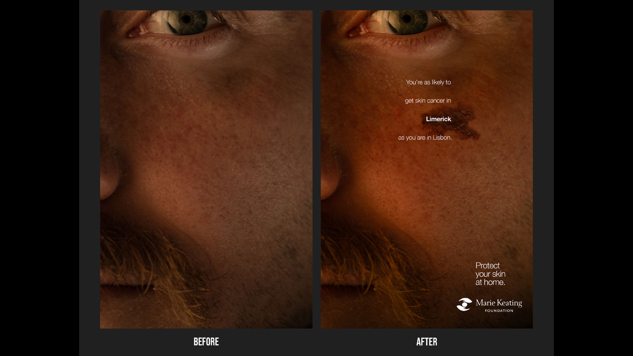 Mole Maps - Skin Cancer - The Marie Keating Foundation