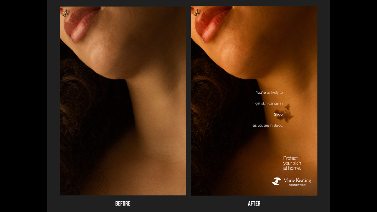 Mole Maps - Skin Cancer - The Marie Keating Foundation
